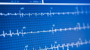 نوار قلب، ECG ، الکتروکاردیوگرام