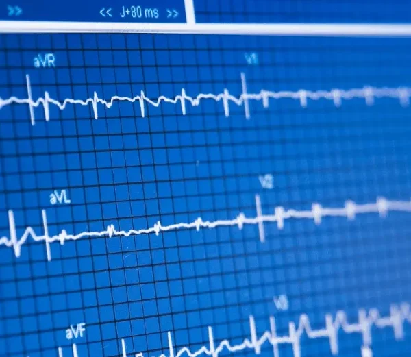 نوار قلب، ECG ، الکتروکاردیوگرام