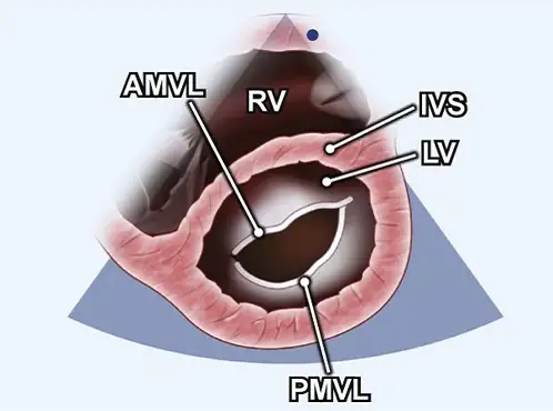 اکو دوبعدی (2D) اکو دوبعدی | RV (بطن راست)، AMVL (لت قدامی دریچه میترال)، IVS (سپتوم بینبطنی)، LV (بطن چپ)، PMVL (لت خلفی دریچه میترال)