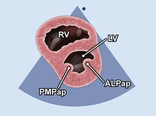 اکو دوبعدی (2D) اکو دوبعدی | RV (بطن راست)، LV (بطن چپ)، PMPap (عضله پاپیلاری خلفی بطن چپ)، ALPap (عضله پاپیلاری قدامی بطن چپ)