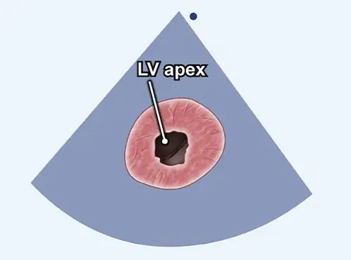 اکو دوبعدی (2D) اکو دوبعدی | LV apex (نوکِ بطن چپ)