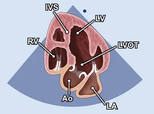 اکو دوبعدی (2D) IVS (سپتوم بینبطنی) LV (بطن چپ) LVOT (خروجی بطن چپ) LA (دهلیز چپ) Ao (آئورت) RV (بطن راست)