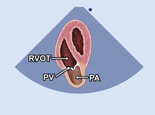 اکو دوبعدی (2D) RVOT (خروجی بطن راست)PV (دریچه ریوی) PA (شریان ریوی)