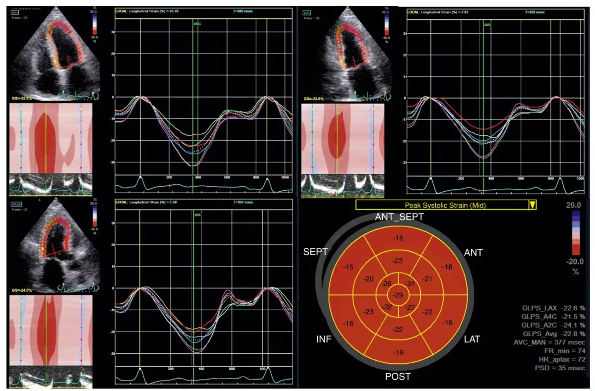 نمونهای از استرین طولی که برای تعیین استرین طولی سراسری (GLS) استفاده میشود. نمای اپیکال چهارحفره (بالا چپ)، نمای اپیکال دوحفره (بالا راست)، نمای اپیکال لانگاکسیس (پایین چپ)، و نمودار قطبی بولزآی (پایین راست). مقدار GLS در این مثال برابر با ۲۲.۸٪ است (بر حسب مقدار مطلق). نمونهای از استرین طولی که برای تعیین استرین طولی سراسری (GLS) استفاده میشود. نمای اپیکال چهارحفره (بالا چپ)، نمای اپیکال دوحفره (بالا راست)، نمای اپیکال لانگاکسیس (پایین چپ)، و نمودار قطبی بولزآی (پایین راست). مقدار GLS در این مثال برابر با ۲۲.۸٪ است (بر حسب مقدار مطلق).