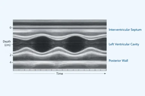 یک تصویر پزشکی ردیابی M‑Mode طبیعی بطن چپ. این تصویر یک نمودار M‑Mode بهصورت خاکستری را نشان میدهد که محور افقی آن زمان و محور عمودی آن عمق است. خطوط حرکتی موازی، واضح و دقیق، **سپتوم بینبطنی، حفره بطن چپ و دیواره خلفی** را نمایش میدهند. سپتوم و دیواره خلفی در سیستول بهصورت متقارن به سمت داخل حرکت میکنند و در دیاستول به سمت خارج بازمیگردند. عرض حفره بطن در سیستول بهطور یکنواخت کاهش یافته و در دیاستول افزایش مییابد. سبک تصویر دقیق، مینیمال و آموزشی است و از رنگهای ملایم بالینی مانند سفید، آبی و خاکستری استفاده میکند. یک تصویر پزشکی ردیابی M‑Mode طبیعی بطن چپ. این تصویر یک نمودار M‑Mode بهصورت خاکستری را نشان میدهد که محور افقی آن زمان و محور عمودی آن عمق است. خطوط حرکتی موازی، واضح و دقیق، **سپتوم بینبطنی، حفره بطن چپ و دیواره خلفی** را نمایش میدهند. سپتوم و دیواره خلفی در سیستول بهصورت متقارن به سمت داخل حرکت میکنند و در دیاستول به سمت خارج بازمیگردند. عرض حفره بطن در سیستول بهطور یکنواخت کاهش یافته و در دیاستول افزایش مییابد. سبک تصویر دقیق، مینیمال و آموزشی است و از رنگهای ملایم بالینی مانند سفید، آبی و خاکستری استفاده میکند.