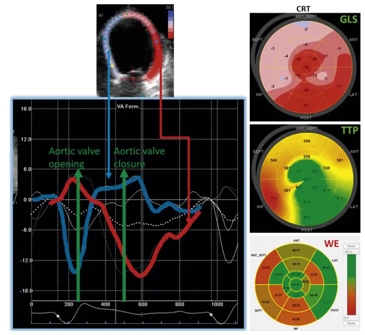 ناسازگاری مکانیکیِ قلب زمانی رخ میدهد که بخشهای مختلف بطن چپ همزمان منقبض نمیشوند و هر سگمنت با زمانبندی متفاوتی وارد فاز انقباض میشود. این پدیده معمولاً در بیماریهایی مانند بلوک شاخهای چپ، کاردیومیوپاتیهای دیلاته یا اختلالات هدایت الکتریکی دیده میشود و اثر آن بهطور مستقیم در منحنیهای استرین طولی (GLS) قابل مشاهده است. در چنین شرایطی، الگوی طبیعی و هماهنگ پیکهای استرین از بین میرود و هر دیواره با تأخیر یا تعجیل نسبت به دیگری به پیک انقباض میرسد.پیامد این ناهماهنگی، کاهش کارایی پمپاژ بطن چپ و افزایش انرژی هدررفته (Wasted Energy) است. قلب برای ایجاد برونده مناسب مجبور است انرژی بیشتری مصرف کند، اما بخشی از این انرژی بهجای تقویت انقباض هماهنگ، صرف حرکات متقابل و ناکارآمد بین سگمنتها میشود. این وضعیت در نهایت میتواند به کاهش GLS و افت عملکرد سیستولی منجر شود. تحلیل دقیق منحنیهای استرین طولی در چنین بیماران، نهتنها الگوی دیسسینکرونی را آشکار میکند، بلکه میتواند در تصمیمگیری برای درمان بازهمزمانسازی قلبی (CRT) نیز نقش مهمی داشته باشد؛ درمانی که هدف آن بازگرداندن هماهنگی زمانی انقباض و کاهش انرژی هدررفته است. ناسازگاری مکانیکیِ قلب زمانی رخ میدهد که بخشهای مختلف بطن چپ همزمان منقبض نمیشوند و هر سگمنت با زمانبندی متفاوتی وارد فاز انقباض میشود. این پدیده معمولاً در بیماریهایی مانند بلوک شاخهای چپ، کاردیومیوپاتیهای دیلاته یا اختلالات هدایت الکتریکی دیده میشود و اثر آن بهطور مستقیم در منحنیهای استرین طولی (GLS) قابل مشاهده است. در چنین شرایطی، الگوی طبیعی و هماهنگ پیکهای استرین از بین میرود و هر دیواره با تأخیر یا تعجیل نسبت به دیگری به پیک انقباض میرسد.پیامد این ناهماهنگی، کاهش کارایی پمپاژ بطن چپ و افزایش انرژی هدررفته (Wasted Energy) است. قلب برای ایجاد برونده مناسب مجبور است انرژی بیشتری مصرف کند، اما بخشی از این انرژی بهجای تقویت انقباض هماهنگ، صرف حرکات متقابل و ناکارآمد بین سگمنتها میشود. این وضعیت در نهایت میتواند به کاهش GLS و افت عملکرد سیستولی منجر شود. تحلیل دقیق منحنیهای استرین طولی در چنین بیماران، نهتنها الگوی دیسسینکرونی را آشکار میکند، بلکه میتواند در تصمیمگیری برای درمان بازهمزمانسازی قلبی (CRT) نیز نقش مهمی داشته باشد؛ درمانی که هدف آن بازگرداندن هماهنگی زمانی انقباض و کاهش انرژی هدررفته است.