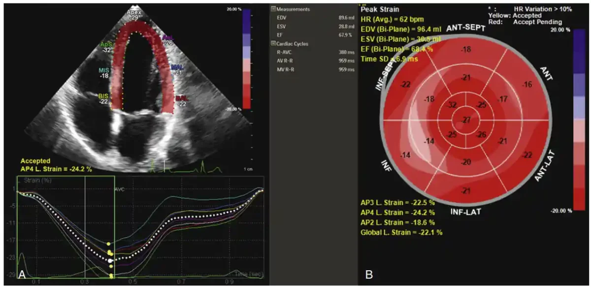 نمونه ای خروجی ماشین از اندازه گیری استرین (کرنش) .تصویربرداری استرین با ردیابی لکه. نمای آپیکال چهارحفرهای از الگوی استرین طبیعی بطن چپ با نمایش رنگی (A) و نمودار ترکیبی چشم گاو (bull’s eye) متناظر (B) نشان میدهند که استرین طولی کلی (GLS) از نمای آپیکال لانگ اکسیس برابر –۲۲.۵٪، از نمای آپیکال چهارحفرهای برابر –۲۴.۲٪ و از نمای آپیکال دوحفرهای برابر –۱۸.۶٪ است، که میانگین استرین طولی –۲۲.۱٪ را میدهد و در محدوده نرمال قرار دارد. نمونه ای خروجی ماشین از اندازه گیری استرین (کرنش). تصویربرداری استرین با ردیابی لکه. نمای آپیکال چهارحفرهای از الگوی استرین طبیعی بطن چپ با نمایش رنگی (A) و نمودار ترکیبی چشم گاو (bull’s eye) متناظر (B) نشان میدهند که استرین طولی کلی (GLS) از نمای آپیکال لانگ اکسیس برابر –۲۲.۵٪، از نمای آپیکال چهارحفرهای برابر –۲۴.۲٪ و از نمای آپیکال دوحفرهای برابر –۱۸.۶٪ است، که میانگین استرین طولی –۲۲.۱٪ را میدهد و در محدوده نرمال قرار دارد.