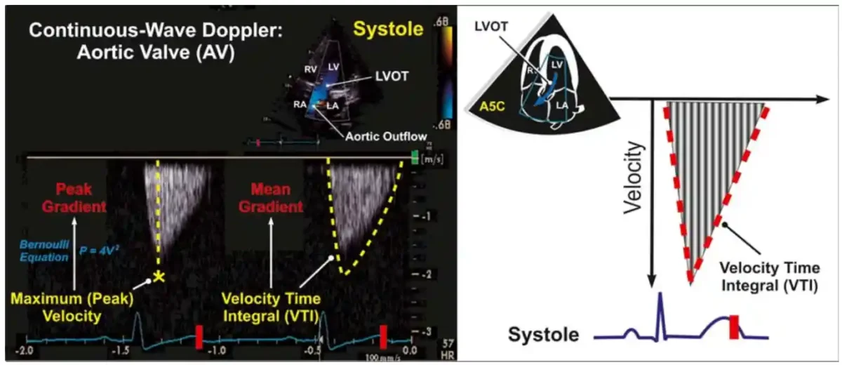 نمای داپلر موج پیوسته دریچه آئورت. نمایش داپلر موج پیوسته (CW) از جریان خروجی آئورت که از نمای پنجحفرهای (A5C) بهدست آمده است. به طیف گسترده فرکانسها/سرعتها توجه کنید که باعث پهنشدن طیف فرکانسی داپلر CW میشود. در مقایسه با داپلر موج پالسی (PW)، نمایش داپلر CW معمولاً **پهنشدگی طیفی** بیشتری دارد و **پنجره پروفایل داپلر پرتر** دیده میشود. این موضوع نشاندهنده وجود **دامنه وسیعی از سرعتها** در حجم نمونه بزرگ داپلر CW است. نمای داپلر موج پیوسته دریچه آئورت. نمایش داپلر موج پیوسته (CW) از جریان خروجی آئورت که از نمای پنجحفرهای (A5C) بهدست آمده است. به طیف گسترده فرکانسها/سرعتها توجه کنید که باعث پهنشدن طیف فرکانسی داپلر CW میشود. در مقایسه با داپلر موج پالسی (PW)، نمایش داپلر CW معمولاً **پهنشدگی طیفی** بیشتری دارد و **پنجره پروفایل داپلر پرتر** دیده میشود. این موضوع نشاندهنده وجود **دامنه وسیعی از سرعتها** در حجم نمونه بزرگ داپلر CW است.