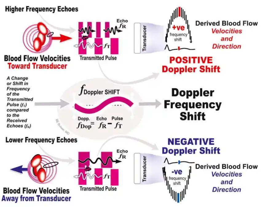 تغییر فرکانس داپلر به معنای تغییر یا جابهجایی فرکانس پژواکهای برگشتی نسبت به فرکانس امواج اولتراسوندی است که دستگاه ارسال کرده است. پنلهای بالا وقتی خون بهسمت پروب حرکت میکند، پژواکهای برگشتی با فرکانس بالاتر از فرکانس موج ارسالی دریافت میشوند. این حالت را تغییر فرکانس مثبت مینامند. پنلهای پایین وقتی خون از پروب دور میشود، عکس این حالت رخ میدهد و فرکانس دریافتی کمتر از فرکانس ارسالی است. در هر دو حالت، اختلاف بین فرکانس موج ارسالشده و فرکانس موج برگشتی همان چیزی است که به آن تغییر فرکانس داپلر یا به اختصار داپلر شیفت گفته میشود که مبنای اندازهگیری سرعت است. تغییر فرکانس داپلر به معنای تغییر یا جابهجایی فرکانس پژواکهای برگشتی نسبت به فرکانس امواج اولتراسوندی است که دستگاه ارسال کرده است. پنلهای بالا وقتی خون بهسمت پروب حرکت میکند، پژواکهای برگشتی با فرکانس بالاتر از فرکانس موج ارسالی دریافت میشوند. این حالت را تغییر فرکانس مثبت مینامند. پنلهای پایین وقتی خون از پروب دور میشود، عکس این حالت رخ میدهد و فرکانس دریافتی کمتر از فرکانس ارسالی است. در هر دو حالت، اختلاف بین فرکانس موج ارسالشده و فرکانس موج برگشتی همان چیزی است که به آن تغییر فرکانس داپلر یا به اختصار داپلر شیفت گفته میشود که مبنای اندازهگیری سرعت است.
