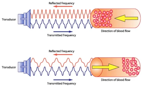 اثر داپلر (Doppler Effect) یعنی تغییر کردن «زیر و بمی» یک صدا، وقتی که منبع آن صدا دارد به سمت ما میآید یا از ما دور میشود.حتماً برایتان پیش آمده که کنار خیابان ایستادهاید و یک آمبولانس با آژیر روشن به شما نزدیک و سپس از شما دور میشود وقتی دارد میآید، صدای آژیر خیلی تیز و نازک (زیر) به گوش میرسد. انگار صداها فشرده شدهاند. وقتی از شما رد میشود و دور میشود، ناگهان صدای آژیر کلفت و بم میشود. انگار صداها کش میآیند. چرا این اتفاق میافتد؟ صدا مثل موج است (شبیه موجهای آب). وقتی ماشین به سمت شما میآید، خودش هم دارد دنبالِ موجهایی که میفرستد میدود؛ پس موجها جلوی ماشین به هم فشرده میشوند (فرکانس بالا میرود). وقتی دور میشود، از موجهای پشت سرش فرار میکند و آنها را از هم باز میکند (فرکانس پایین میآید).در پزشکی، ما به جای آمبولانس، با گلبولهای قرمز خون سر و کار داریم.دستگاه اکو یک «پروپ» دارد که امواج صوتی با فرکانس بسیار بالا (اولتراسوند) میفرستد. این امواج به گلبولهای خون که در حال حرکت هستند برخورد میکنند و برمیگردند.اگر خون به سمت پروپ بیاید، امواج بازگشتی فشرده میشوند (فرکانسشان زیاد میشود). دستگاه این را حس میکند و میفهمد خون دارد به این سمت میآید. اگر خون از پروپ دور شود: امواج بازگشتی کش میآیند (فرکانسشان کم میشود). دستگاه میفهمد خون دارد دور میشود. دکترها با استفاده از این تکنولوژی، میتوانند بفهمند در قلب شما چه میگذرد، بدون اینکه آن را باز کنند: تشخیص تنگی دریچه، اگر دریچه قلب تنگ باشد، خون مجبور است با فشار و سرعت خیلی زیاد (مثل شیلنگ آبی که سرش را سفت گرفتهاید) از آن رد شود. داپلر این سرعت بالا را نشان میدهد. اگر دریچه خوب بسته نشود و خون به عقب نشت کند، داپلر جهتِ اشتباه حرکت خون را نشان میدهد.اثر داپلر در اکو، مثل یک «پلیس بزرگراه» عمل میکند که با دوربین سرعتسنج (که آن هم با همین قانون کار میکند)، سرعت و جهت حرکت ماشینها (گلبولهای خون) را در اتوبانهای قلب شما زیر نظر دارد. اثر داپلر (Doppler Effect) یعنی تغییر کردن «زیر و بمی» یک صدا، وقتی که منبع آن صدا دارد به سمت ما میآید یا از ما دور میشود.حتماً برایتان پیش آمده که کنار خیابان ایستادهاید و یک آمبولانس با آژیر روشن به شما نزدیک و سپس از شما دور میشود وقتی دارد میآید، صدای آژیر خیلی تیز و نازک (زیر) به گوش میرسد. انگار صداها فشرده شدهاند.وقتی از شما رد میشود و دور میشود، ناگهان صدای آژیر کلفت و بم میشود. انگار صداها کش میآیند. چرا این اتفاق میافتد؟ صدا مثل موج است (شبیه موجهای آب). وقتی ماشین به سمت شما میآید، خودش هم دارد دنبالِ موجهایی که میفرستد میدود؛ پس موجها جلوی ماشین به هم فشرده میشوند (فرکانس بالا میرود). وقتی دور میشود، از موجهای پشت سرش فرار میکند و آنها را از هم باز میکند (فرکانس پایین میآید).در پزشکی، ما به جای آمبولانس، با گلبولهای قرمز خون سر و کار داریم.دستگاه اکو یک «پروپ» دارد که امواج صوتی با فرکانس بسیار بالا (اولتراسوند) میفرستد. این امواج به گلبولهای خون که در حال حرکت هستند برخورد میکنند و برمیگردند.اگر خون به سمت پروپ بیاید، امواج بازگشتی فشرده میشوند (فرکانسشان زیاد میشود). دستگاه این را حس میکند و میفهمد خون دارد به این سمت میآید. اگر خون از پروپ دور شود: امواج بازگشتی کش میآیند (فرکانسشان کم میشود). دستگاه میفهمد خون دارد دور میشود. دکترها با استفاده از این تکنولوژی، میتوانند بفهمند در قلب شما چه میگذرد، بدون اینکه آن را باز کنند: تشخیص تنگی دریچه، اگر دریچه قلب تنگ باشد، خون مجبور است با فشار و سرعت خیلی زیاد (مثل شیلنگ آبی که سرش را سفت گرفتهاید) از آن رد شود. داپلر این سرعت بالا را نشان میدهد. اگر دریچه خوب بسته نشود و خون به عقب نشت کند، داپلر جهتِ اشتباه حرکت خون را نشان میدهد.اثر داپلر در اکو، مثل یک «پلیس بزرگراه» عمل میکند که با دوربین سرعتسنج (که آن هم با همین قانون کار میکند)، سرعت و جهت حرکت ماشینها (گلبولهای خون) را در اتوبانهای قلب شما زیر نظر دارد.