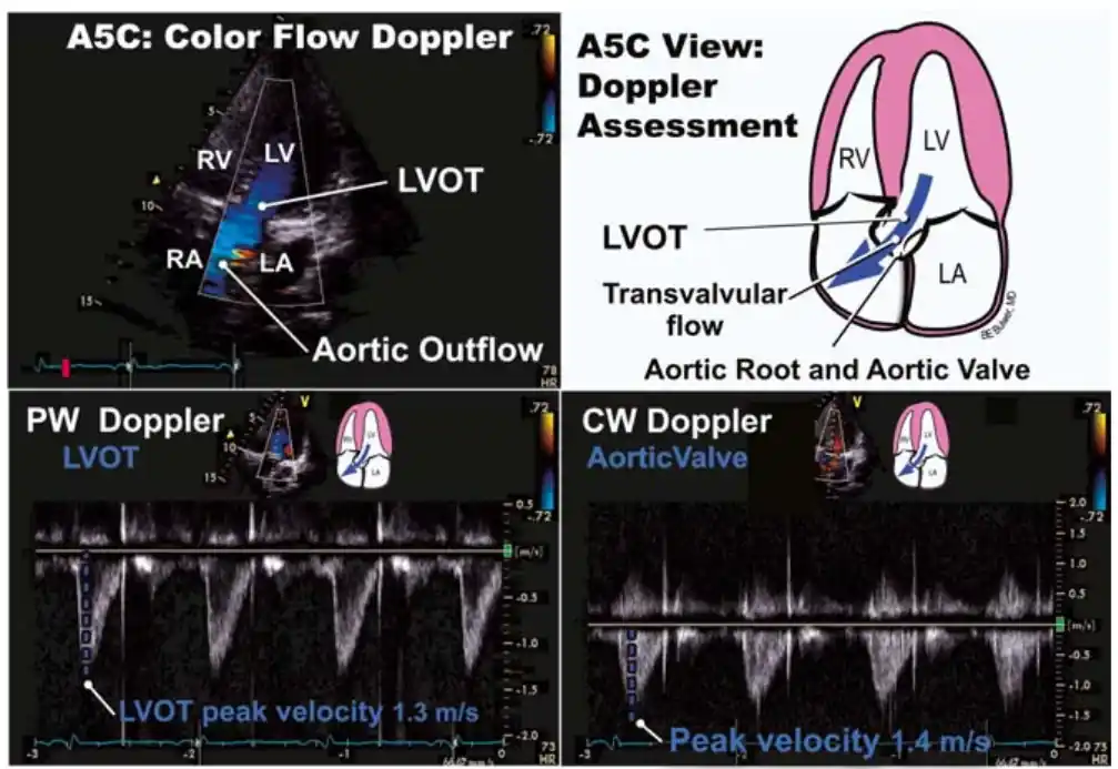ارزیابی داپلر در نمای پنجحفرهای اپیکال. در پنل بالا یک اکوی معمولی دیده میشود که در جلوی تصویر جریانها آبی آن را به یک اکوی داپلر رنگی تبدیل میکند. در فریم سیستول، جریانهای آبیرنگ دیده میشوند که از بطن چپ (LV) وارد خروجی بطن چپ (LVOT) و سپس ریشهٔ آئورت (Ao) میشوند. در پنل پایین بررسی داپلر طیفی PW و CWکه نموداری هستند نمایش داده شده تا تفاوت سه نوع اکو (معمولی، داپلر رنگی و داپلر طیفی) مشخص گردد. داپلر پالسی که نوعی داپلر طیفی است در ناحیهٔ پروگزیمالِ دریچهٔ آئورت برای اندازهگیری سرعتها در سطح LVOT و داپلر موج پیوسته (CW) که نوع دیگر داپلر طیفی است برای ثبت بیشترین سرعتهای عبوری از آئورت به کار گرفته شدهاند.