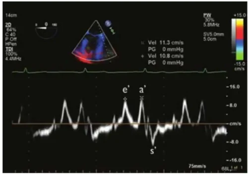 اندازهگیری داپلر بافتی حلقهٔ میترال که سرعتهای s' ، e' و a' را نشان میدهد.