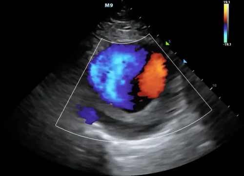 نمایی از اکوی داپلر، دیواره ها با طیف رنگهای سیاه و سفید و جریانها با رنگهای متنوع تر (قرمز نزدیک شونده به پروب و آبی دور شونده از پروب) نمایش داده میشوند. نمایی از اکوی داپلر، دیواره ها با طیف رنگهای سیاه و سفید و جریانها با رنگهای متنوع تر (قرمز نزدیک شونده به پروب و آبی دور شونده از پروب) نمایش داده میشوند.
