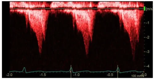 تصویر نمونهای از موج داپلر طیفی را نمایش میدهد که با اکوی معمولی کاملاً متفاوت است. اکوی معمولی به طور زنده دیوارههای اعضای داخلی را در نمایش میدهد در حالیکه داپلر طیفی سرعتسنجی سیالات را انجام میدهد. تصویر نمونهای از موج داپلر طیفی را نمایش میدهد که با اکوی معمولی کاملاً متفاوت است. اکوی معمولی به طور زنده دیوارههای اعضای داخلی را در نمایش میدهد در حالیکه داپلر طیفی سرعتسنجی سیالات را انجام میدهد.