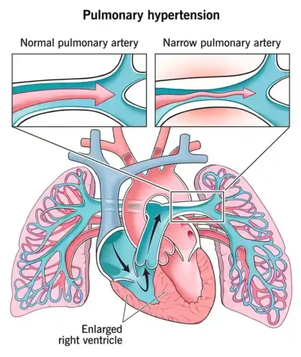 فشار خون ریوی ناشی از تنگشدگی رگ بر اساس سرعت جریان خون قابل اندازه گیری است. حال نرمال و حالت تنگ شده نمایش داده شده است. تشخیص خطیر بودن وضعیت با پزشک است.