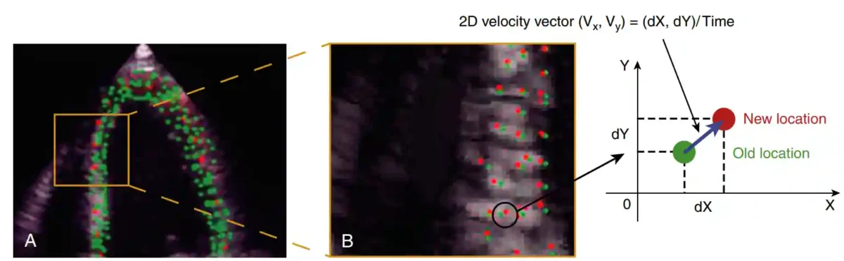 اصل ردیابی لکه در اکوکاردیوگرافی. نرمافزار استرین نشانگرهای صوتی طبیعی داخل سگمنتهای دیواره میوکارد را شناسایی میکند (A)، که در تصویر بزرگنماییشده نیز نشان داده شده است (B). نقطه سبز در نمایش گرافیکی موقعیت قبلی و نقطه قرمز موقعیت جدید همان نشانگر صوتی طبیعی را در دو فریم متوالی نمایش میدهد.از روی تغییر مختصات جابجایی و با تقسیم بر زمان سرعت حرکت به دست میآید و با داشتن سرعت حرکت، مقدار کرنش (تغییر شکل) که ممکن است فشردگی یا کشیدگی باشد حاصل میآید. اصل ردیابی لکه در اکوکاردیوگرافی. نرمافزار استرین نشانگرهای صوتی طبیعی داخل سگمنتهای دیواره میوکارد را شناسایی میکند (A)، که در تصویر بزرگنماییشده نیز نشان داده شده است (B). نقطه سبز در نمایش گرافیکی موقعیت قبلی و نقطه قرمز موقعیت جدید همان نشانگر صوتی طبیعی را در دو فریم متوالی نمایش میدهد.از روی تغییر مختصات جابجایی و با تقسیم بر زمان سرعت حرکت به دست میآید و با داشتن سرعت حرکت، مقدار کرنش (تغییر شکل) که ممکن است فشردگی یا کشیدگی باشد حاصل میآید.