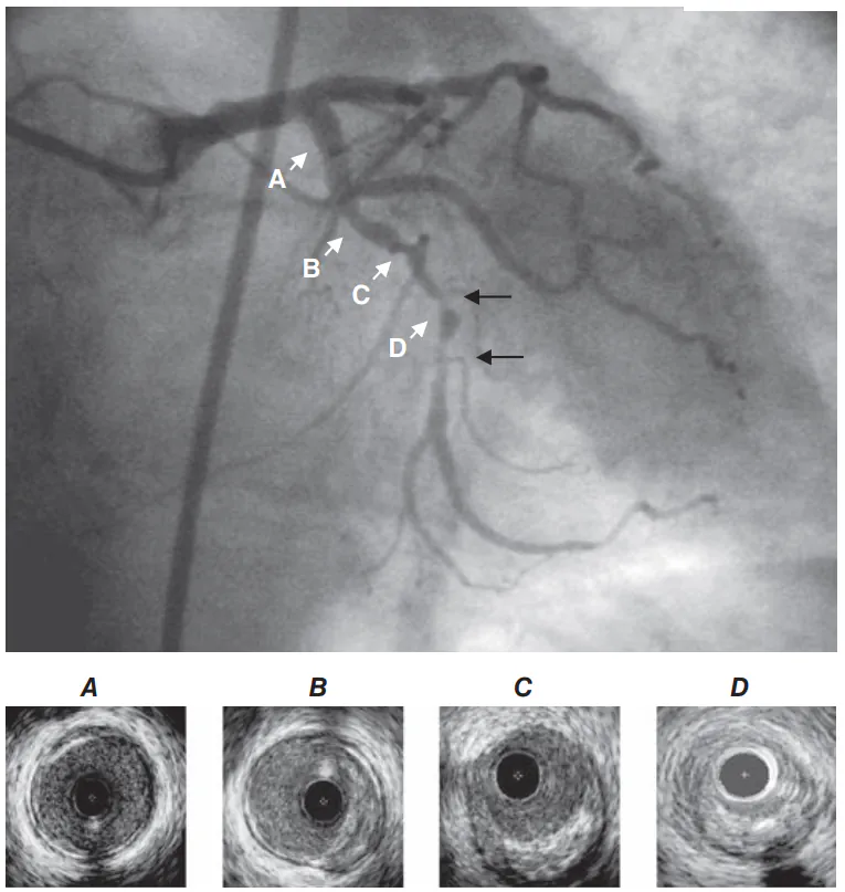 آنژیوگرافی تنگیهای کرونری در آنژیوگرافی سینِه (Cine Angiogram) و اولتراسوند داخل عروقی (IVUS). تنگیهای قابل توجه در شریان کرونر به صورت باریک شدن رگ (فلشهای سیاه) دیده میشوند. اولتراسوند داخل عروقی یک بخش طبیعی از شریان (A)، نواحی دارای پلاک اکسنتریک یا نامتقارن (B و C)، و تقریباً بسته شدن کامل لومن در محل تنگی شدید (D) را نشان میدهد. توجه داشته باشید که کاتتر اولتراسوند داخل عروقی در تصاویر به صورت یک دایره سیاه دیده میشود.