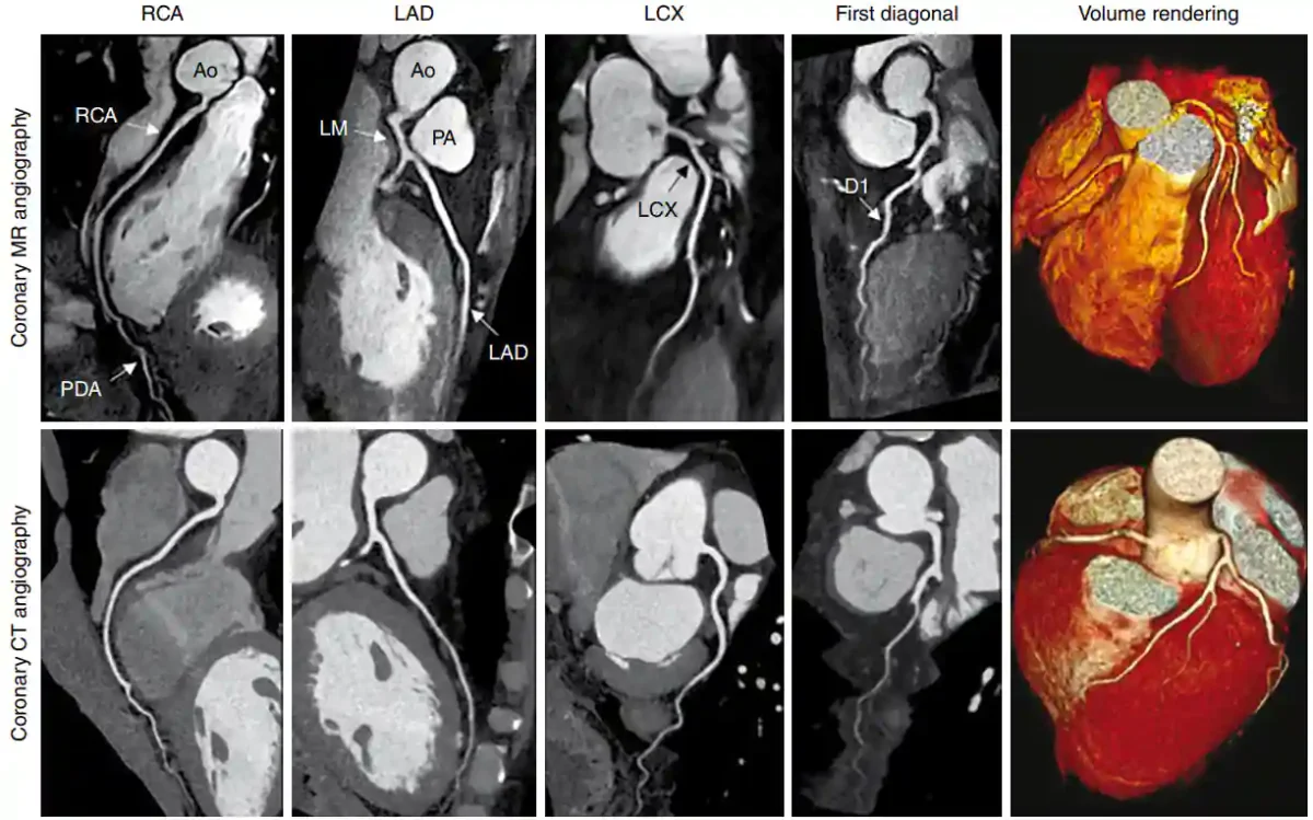 MRI قلب چیست؟ راهنمای کامل تصویربرداری MRI قلب، کاربردها، مزایا و نحوه انجام آنژیوگرافی MRI قلبی
