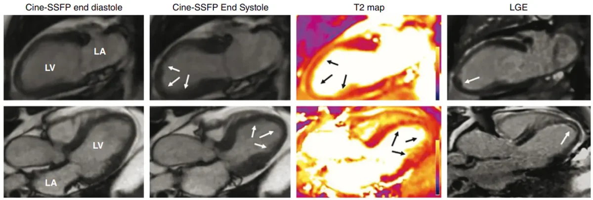 MRI قلب چیست؟ راهنمای کامل تصویربرداری MRI قلب، کاربردها، مزایا و نحوه انجام تصویربرداری MRI در بیماری مبتلا به سندرم تاکوتسوبو