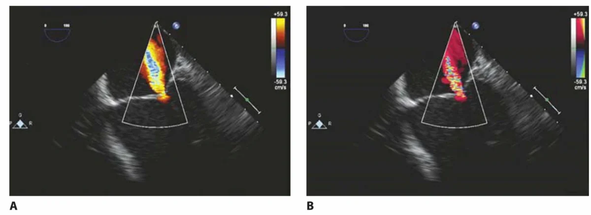 اکوکاردیوگرافی داپلر رنگی (Color flow Doppler imaging) را می‌توان با دو نوع نقشه انجام داد:یک نقشهٔ تقویت‌شده یا سرعت-محور (A) [velocity map: نقشه‌ای که جهت و سرعت جریان خون را با رنگ نشان می‌دهد] در مقابل یک نقشهٔ واریانس (B) [variance map: نقشه‌ای که علاوه بر جهت و سرعت، میزان بی‌نظمی و آشفتگی جریان خون را نیز نشان می‌دهد]. در تصویر A (نقشهٔ سرعت) فقط اطلاعات مربوط به جهت جریان خون و سرعت جریان خون دیده می‌شود. اما در تصویر B (نقشهٔ واریانس) علاوه بر این موارد، اطلاعات اضافی برای تشخیص آشفتگی جریان خون [turbulence] در جت نارسایی میترال [mitral regurgitation jet: جریانی از خون که به دلیل نشت دریچهٔ میترال به‌طور غیرطبیعی از بطن چپ به دهلیز چپ برمی‌گردد] اضافه شده است.