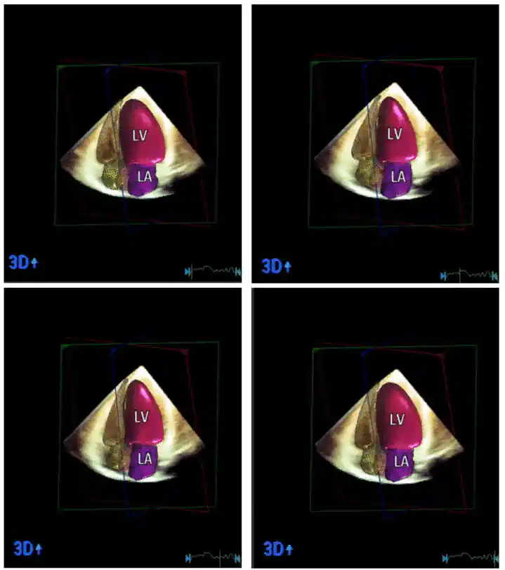 مقایسه نتایج اکوکاردیوگرافی مبتنی بر هوش مصنوعیheartModel AI با MRI قلبی (CMR) مدل سهبعدی خروجی HeartModelAI